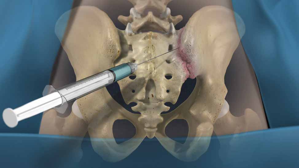 SI Joint Injections Airport Plaza Spine and Wellness 1 Pain
