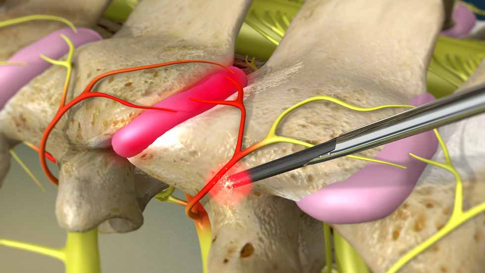 RadioFrequency Ablation Airport Plaza Spine and Wellness The Best