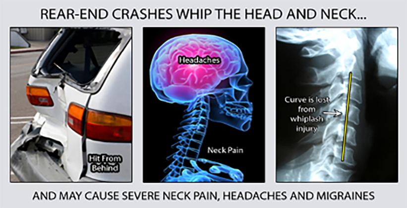 Identifying Whiplash Symptoms After a Car Accident