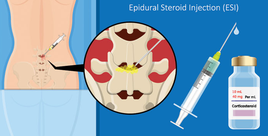 HOW LONG DO EPIDURAL STEROID INJECTIONS FOR SCIATICA LAST