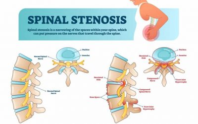 Understanding Spinal Stenosis: Causes, Symptoms, and Treatment Options