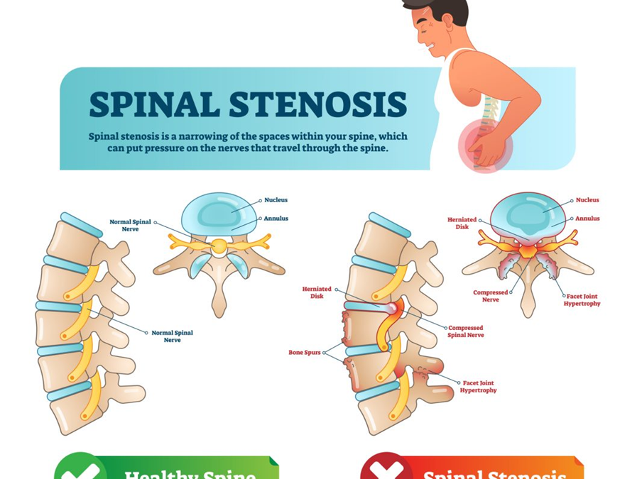 Treatments for Spinal Stenosis