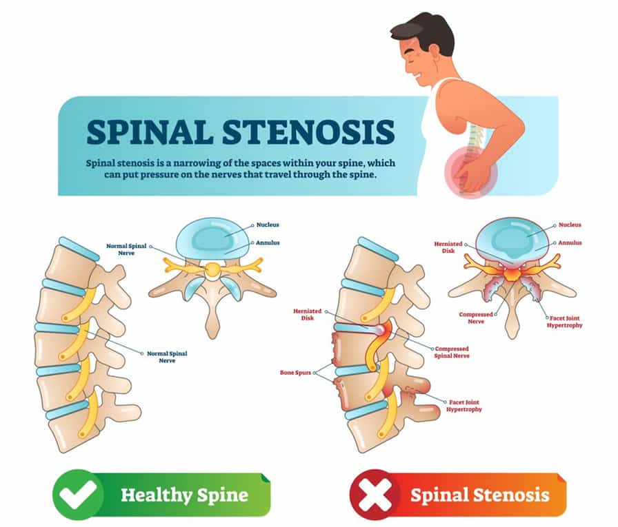 Understanding Spinal Stenosis