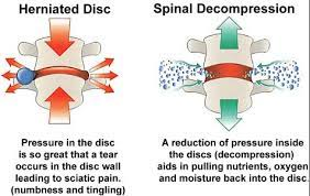 Benefits of Spinal Decompression