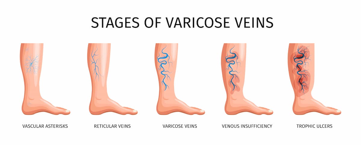 Improve Circulation Naturally