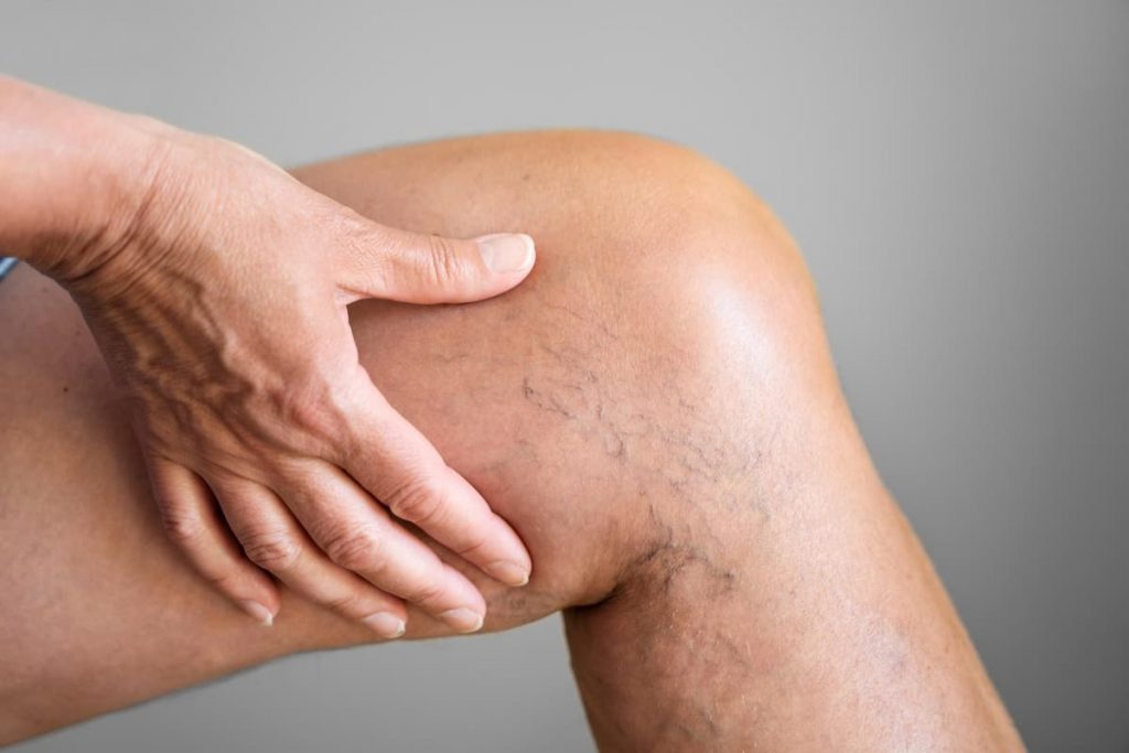 Vascular Treatment