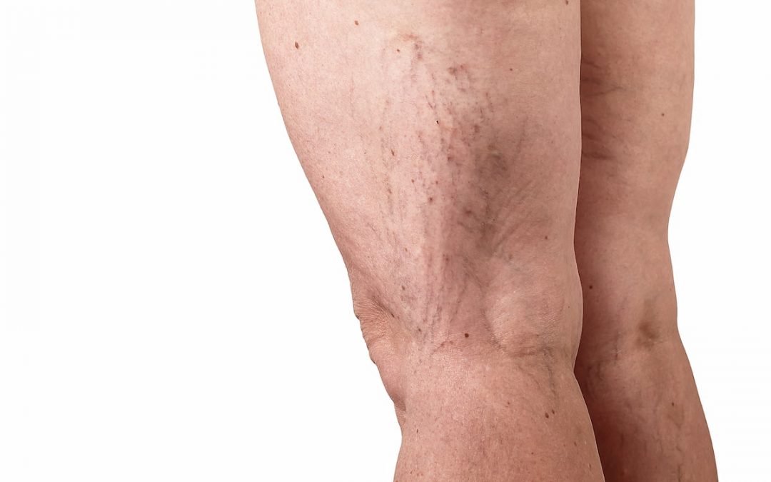 Varicose Vein Treatments