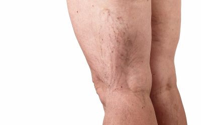Vascular Treatments for Varicose Veins and Chronic Leg Discomfort