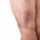 Vascular Treatments for Varicose Veins and Chronic Leg Discomfort