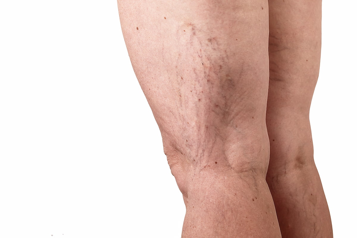 Varicose Vein Treatments
