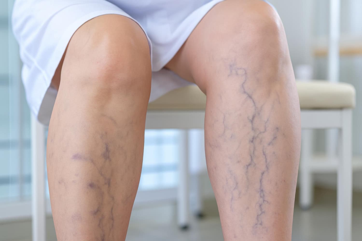 Leg Swelling