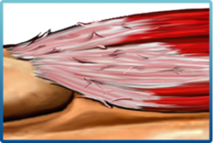 Picture2 1 300x202 1 HydroCision TenJet HydroCision TenJet,Chiropractic Services in Hazlet,tendinitis,Regenerative medicine NJ,TenJet procedure Hazlet Airport Plaza Spine and Wellness